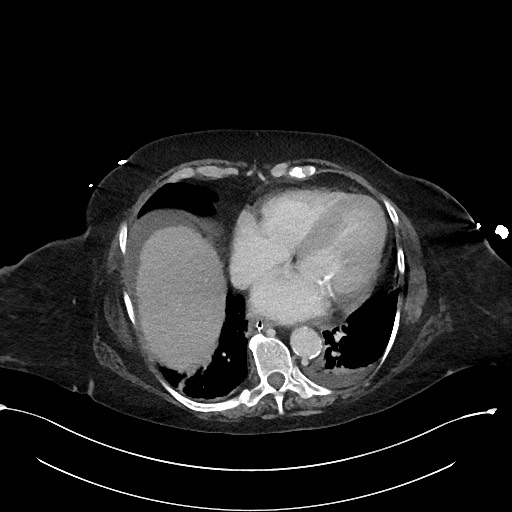 File:Active renal extravasation with large subcapsular and retroperitoneal hemorrhage (Radiopaedia 60975-68796 Axial 347).jpg