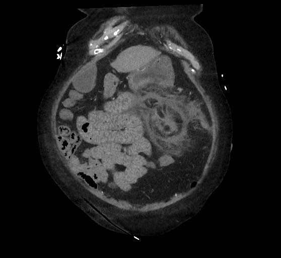 Active renal extravasation with large subcapsular and retroperitoneal hemorrhage (Radiopaedia 60975-68796 Coronal C+ arterial phase 37).jpg