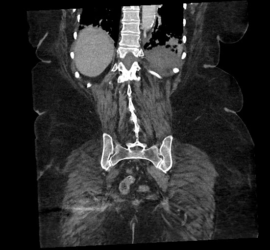 File:Active renal extravasation with large subcapsular and retroperitoneal hemorrhage (Radiopaedia 60975-68796 Coronal C+ portal venous phase 122).jpg