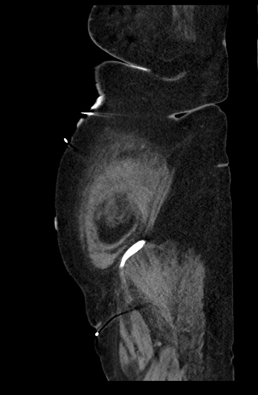 Active renal extravasation with large subcapsular and retroperitoneal hemorrhage (Radiopaedia 60975-68796 Sagittal C+ portal venous phase 41).jpg