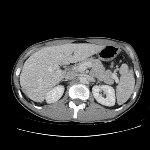 Acute appendicitis (Radiopaedia 27049-27227 Axial C+ portal venous phase 21).jpg