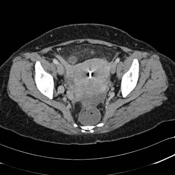 File:Acute appendicitis (Radiopaedia 48792-53822 Axial C+ portal venous phase 102).jpg