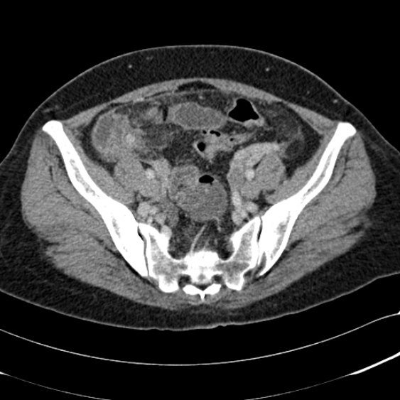 Acute appendicitis (Radiopaedia 48792-53822 Axial C+ portal venous phase 91).jpg