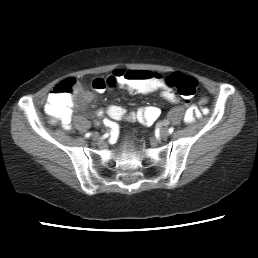 File:Acute appendicitis (Radiopaedia 52672-58589 Axial C+ arterial phase 18).jpg