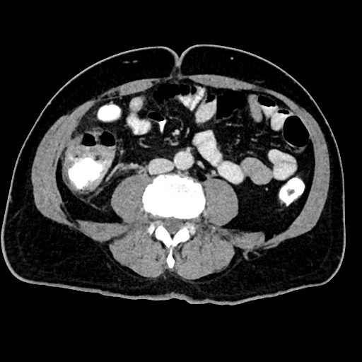 File:Acute appendicitis (Radiopaedia 77016-88960 Axial C+ portal venous phase 84).jpg