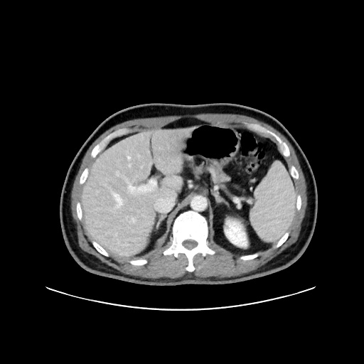 File:Acute appendicitis and COVID 19 pneumonia (Radiopaedia 76604-88380 Axial C+ portal venous phase 21).jpg