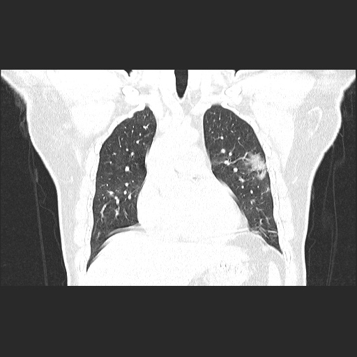 Acute appendicitis and COVID 19 pneumonia (Radiopaedia 76604-88380 G 25).jpg