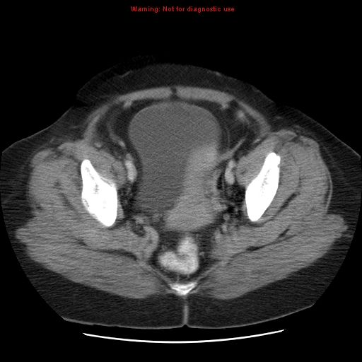 Acute appendicitis complicated by ovarian vein thrombophlebitis (Radiopaedia 16172-15851 Axial C+ portal venous phase 78).jpg