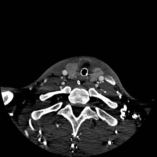 Acute basilar artery occlusion (Radiopaedia 43582-46985 Axial C+ arterial phase 269).jpg
