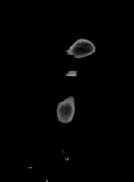 Acute bowel ischemia (Radiopaedia 87695-104114 Coronal C+ portal venous phase 48).jpg