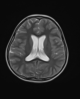 File:Acute cerebellar ataxia (Radiopaedia 61487-69446 Axial T2 14).jpg