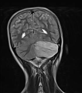 File:Acute cerebellar ataxia (Radiopaedia 61487-69446 Coronal T2 13).jpg