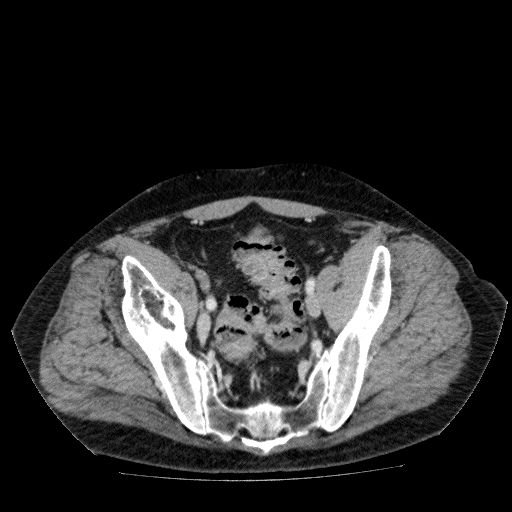 File:Acute cholecystitis and incidental left sided IVC (Radiopaedia 49352-54459 Axial C+ portal venous phase 128).jpg