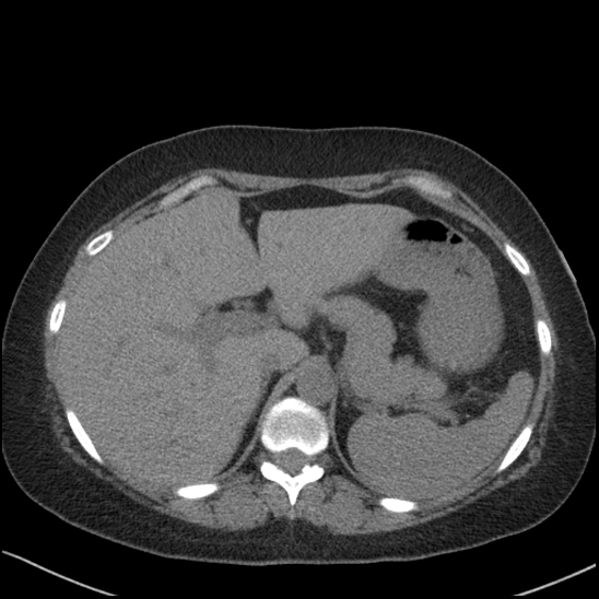 Acute colonic hemorrhage in ulcerative colitis (Radiopaedia 77415-89538 Axial non-contrast 30).jpg