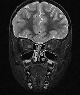 File:Acute disseminating encephalomyelitis with bilateral optic neuritis (Radiopaedia 79676-92886 Coronal STIR 8).jpg