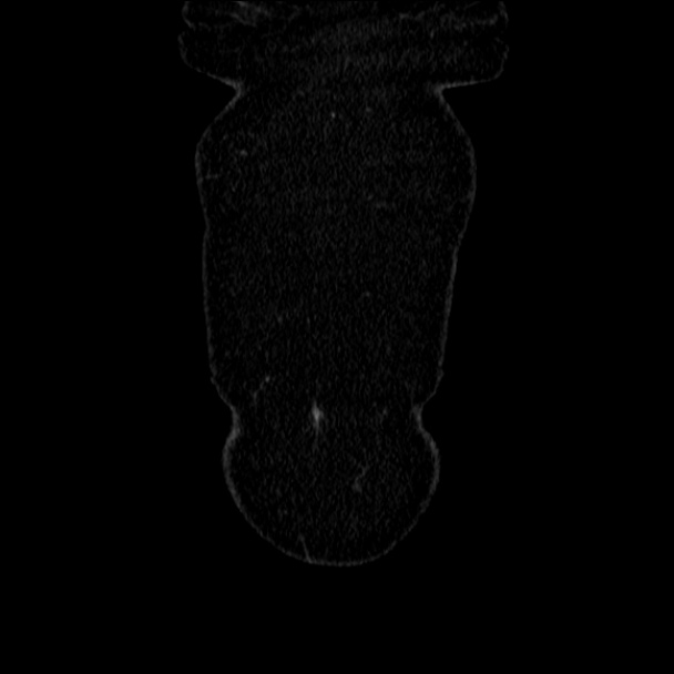 Acute diverticulitis (Radiopaedia 34183-35442 Coronal C+ portal venous phase 6).jpg