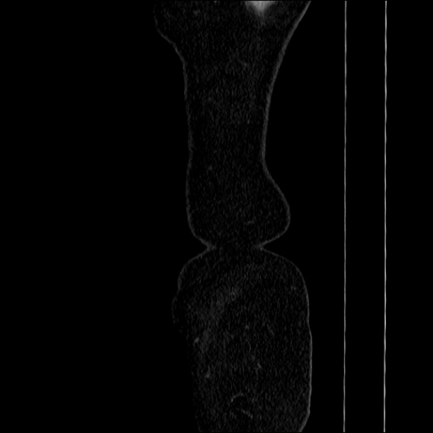 Acute diverticulitis (Radiopaedia 34183-35442 Sagittal C+ portal venous phase 1).jpg