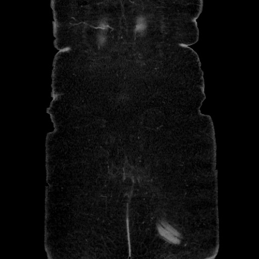 Acute diverticulitis - transverse colon (Radiopaedia 87063-103327 Coronal C+ portal venous phase 153).jpg