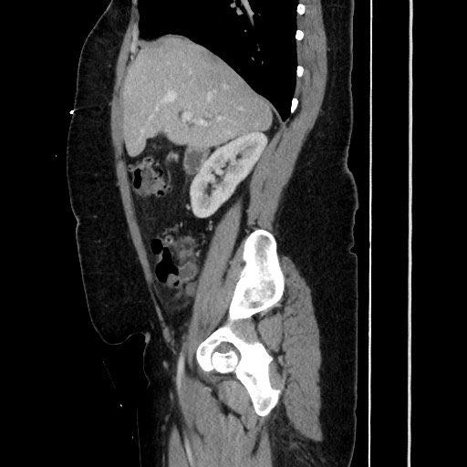 Acute diverticulitis - transverse colon (Radiopaedia 87063-103327 Sagittal C+ portal venous phase 90).jpg
