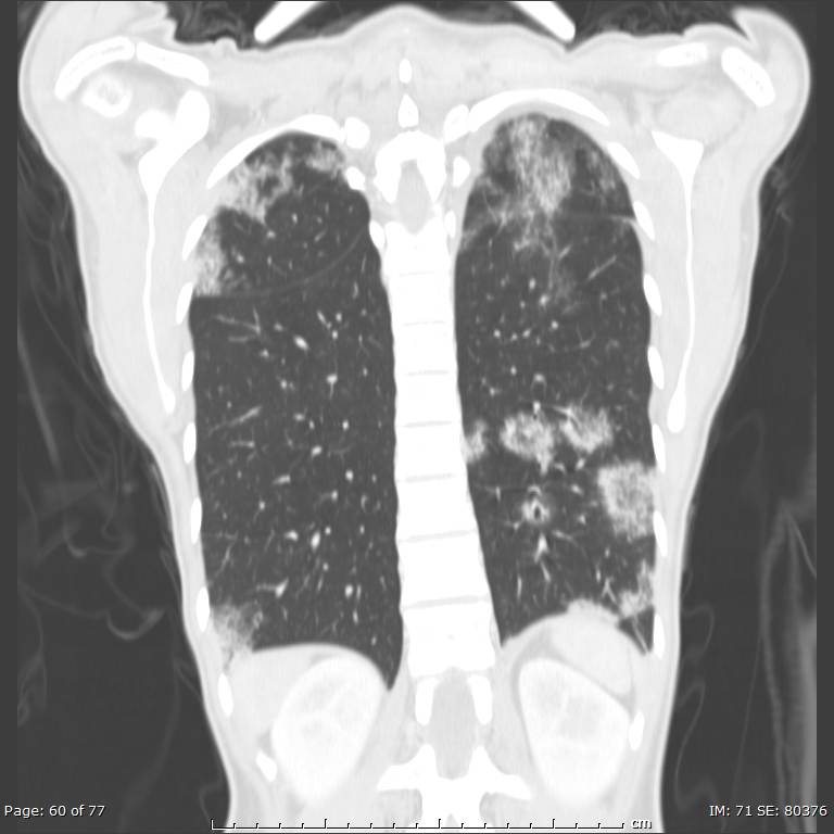 Acute eosinophilic pneumonia (Radiopaedia 48211-53073 Coronal lung window 41).jpg