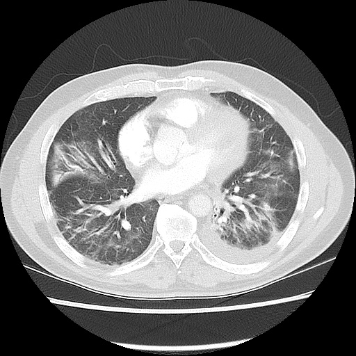 Acute epicardial fat necrosis (Radiopaedia 42327-45440 Axial lung window 36).jpg