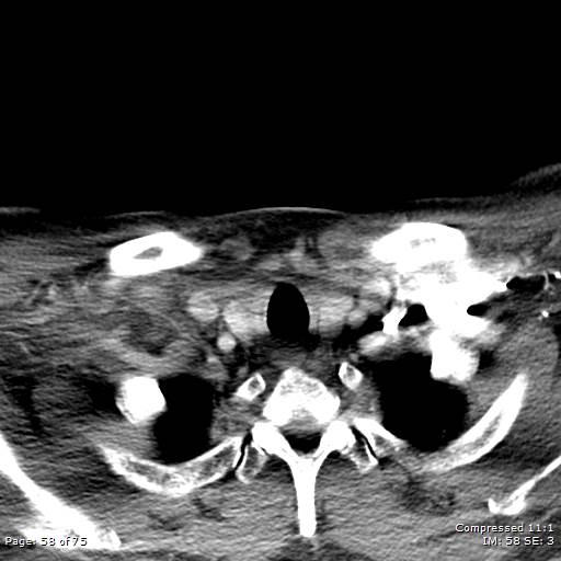 Acute epiglottitis (Radiopaedia 54375-60590 Axial C+ arterial phase 58).jpg
