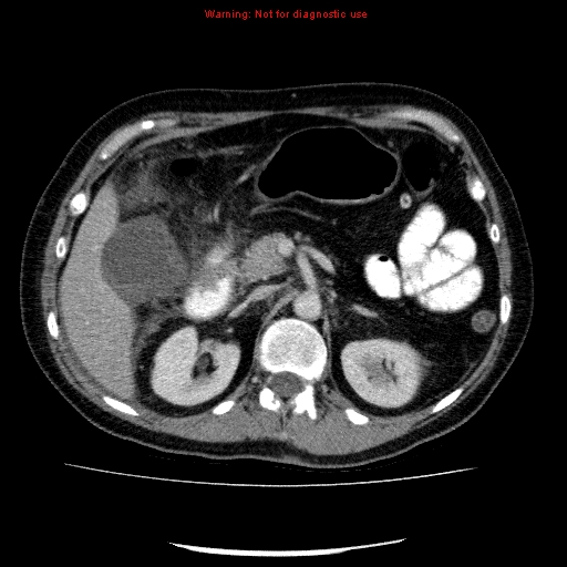 Acute gangrenous cholecystitis (Radiopaedia 10123-10661 Axial C+ portal venous phase 34).jpg