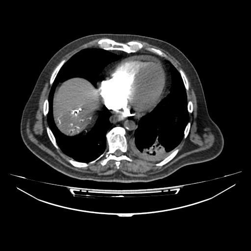 Acute heart failure (CT) (Radiopaedia 79835-93075 Axial C+ arterial phase 44).jpg