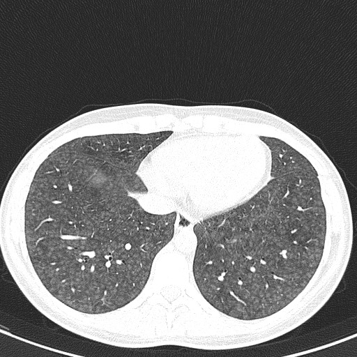 File:Acute hypersensitivity pneumonitis (Radiopaedia 85293-100870 Axial lung window 91).jpg