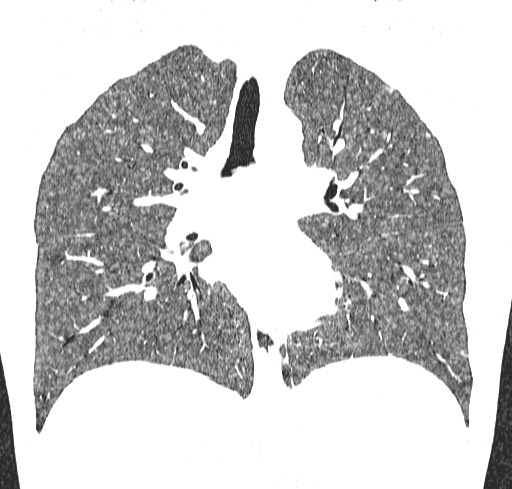 Acute hypersensitivity pneumonitis (Radiopaedia 85293-100870 Coronal lung window 68).jpg