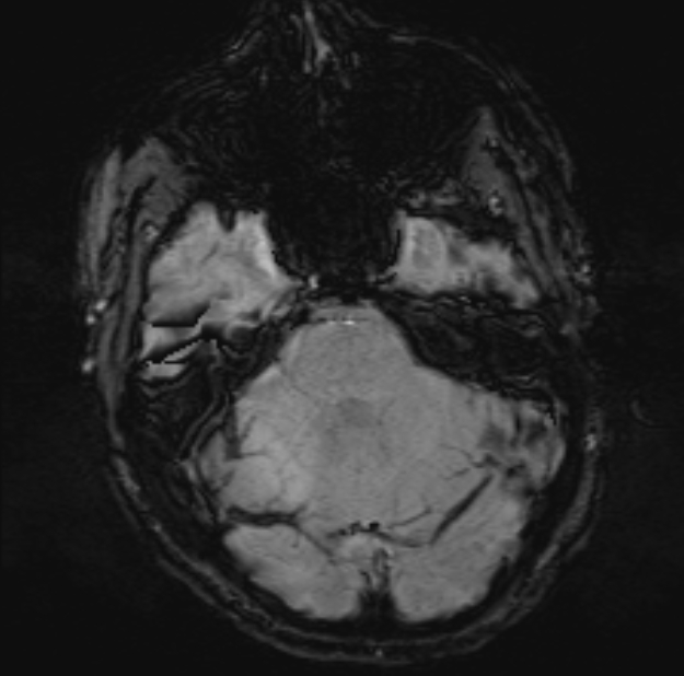 Acute ischemic stroke - posterior circulation territory (Radiopaedia 77670-89880 Axial SWI 17).jpg