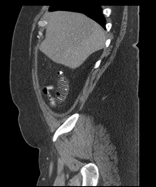 Acute mesenteric venous ischemia (Radiopaedia 46041-50383 Sagittal C+ portal venous phase 18).jpg