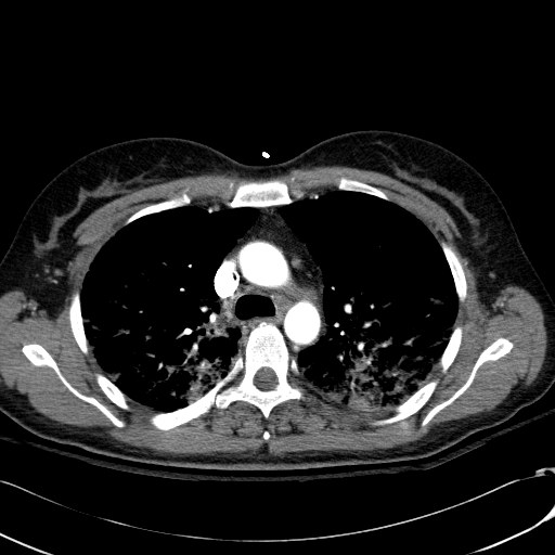 Acute myocardial infarction in CT (Radiopaedia 39947-42415 Axial C+ arterial phase 44).jpg