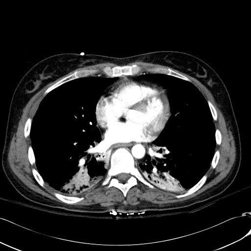 Acute myocardial infarction in CT (Radiopaedia 39947-42415 Axial C+ arterial phase 84).jpg