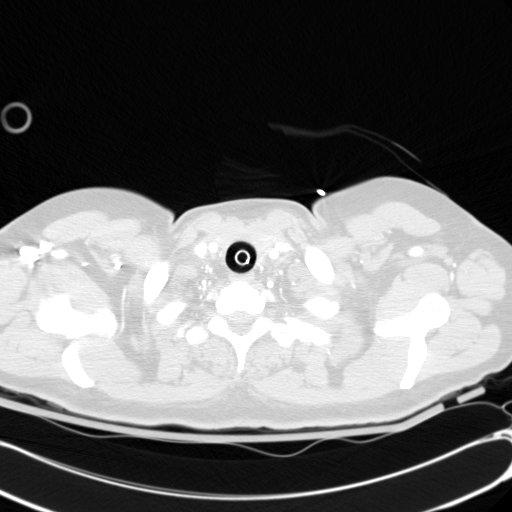Acute myocardial infarction in CT (Radiopaedia 39947-42415 Axial lung window 1).jpg