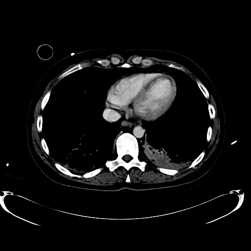File:Acute myocardial infarction in CT (Radiopaedia 39947-42457 Axial C+ portal venous phase 10).jpg