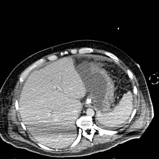 File:Acute pancreatic necrosis (Radiopaedia 13560-18501 Axial C+ portal venous phase 21).jpg