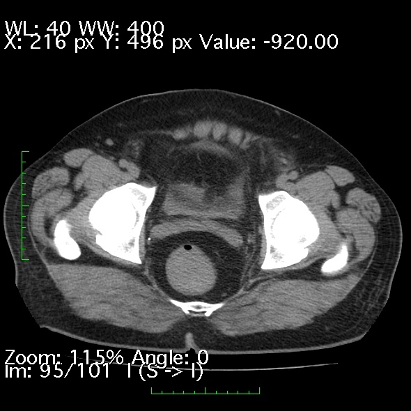 Acute pancreatitis (Radiopaedia 34043-35276 Axial non-contrast 95).jpg