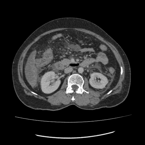 Acute pancreatitis (Radiopaedia 80007-93285 Axial C+ portal venous phase 85).jpg