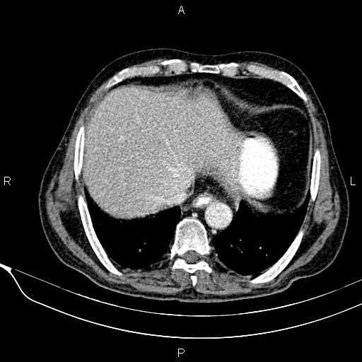 Acute pancreatitis (Radiopaedia 85146-100701 Axial C+ portal venous phase 13).jpg