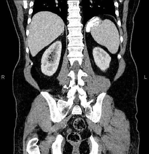 Acute pancreatitis (Radiopaedia 85390-101010 Coronal C+ portal venous phase 55).jpg