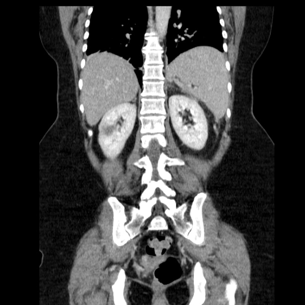 Acute pancreatitis - Balthazar C (Radiopaedia 26569-26714 Coronal C+ portal venous phase 49).jpg