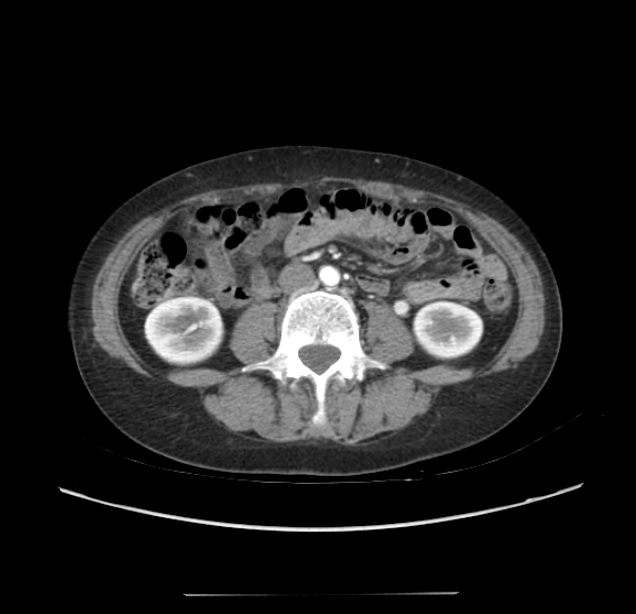 File:Acute pancreatitis - Balthazar E - post ERCP (Radiopaedia 27562-27772 Axial C+ arterial phase 34).png