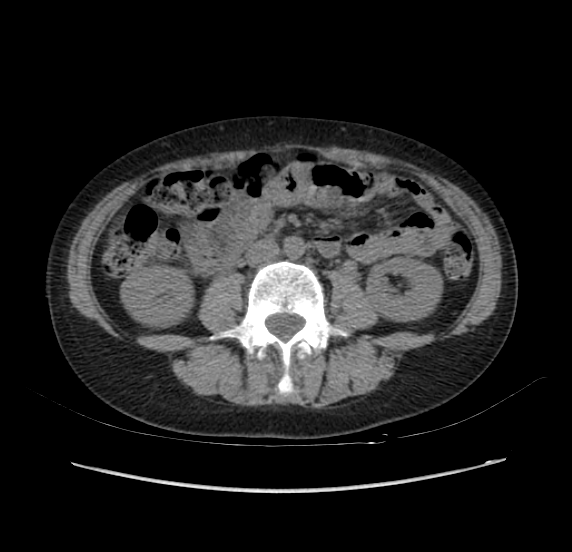 File:Acute pancreatitis - Balthazar E - post ERCP (Radiopaedia 27562-27772 Axial non-contrast 34).png