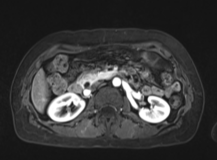 Acute pancreatitis - Balthazar E - post ERCP (Radiopaedia 27562-27778 Axial VIBE C+ 52).png