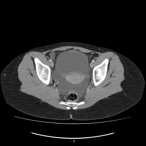 Acute pancreatitis secondary to stone at minor papilla and pancreatic divisum (Radiopaedia 76570-88333 Axial C+ portal venous phase 71).jpg