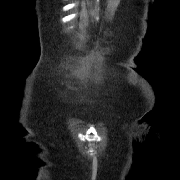 Acute pyelonephritis (Radiopaedia 26584-26729 C+ portal venous phase 71).jpg