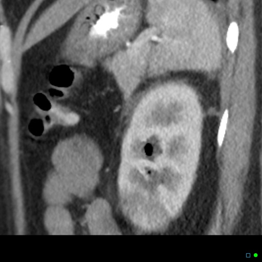 File:Acute pyelonephritis and emphysematous pyonephrosis (Radiopaedia 27893-28128 renal cortical phase 5).jpg