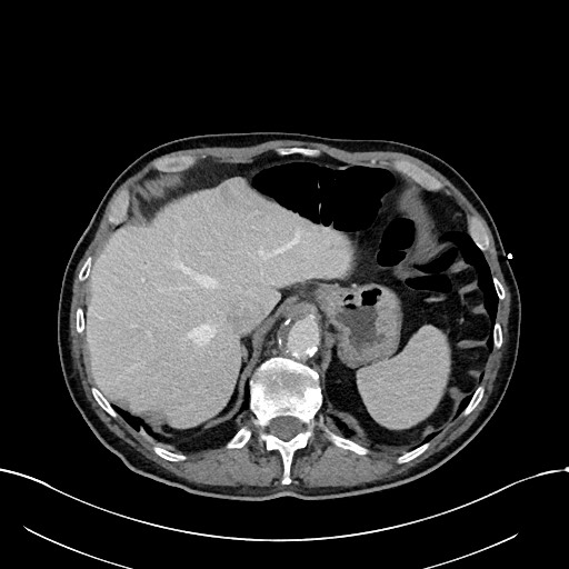 File:Acute renal infarction (Radiopaedia 59375-66736 Axial C+ portal venous phase 16).jpg