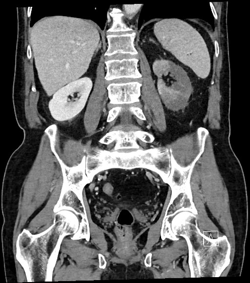 Acute renal infarction (Radiopaedia 59375-66736 Coronal C+ portal venous phase 42).jpg